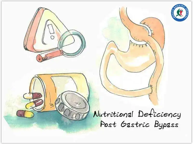 Nutritional Deficiency After Gastric Bypass