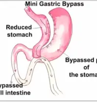 Mini Gastric Bypass in Mexico Complete Guide: Cost, Process, and Benefits Mini Gastric Bypass in Mexico