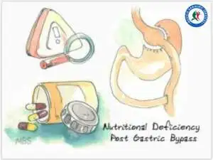 Nutritional deficiency post gastric bypass