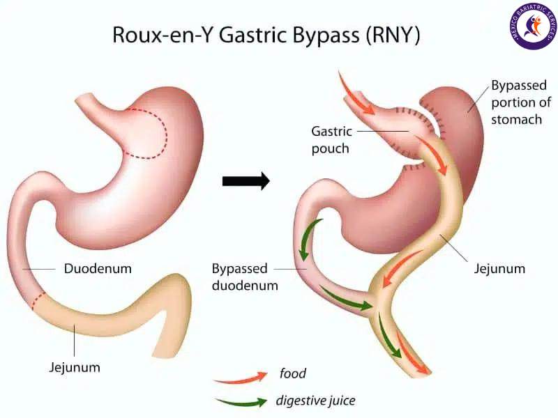 Gastric Bypass 