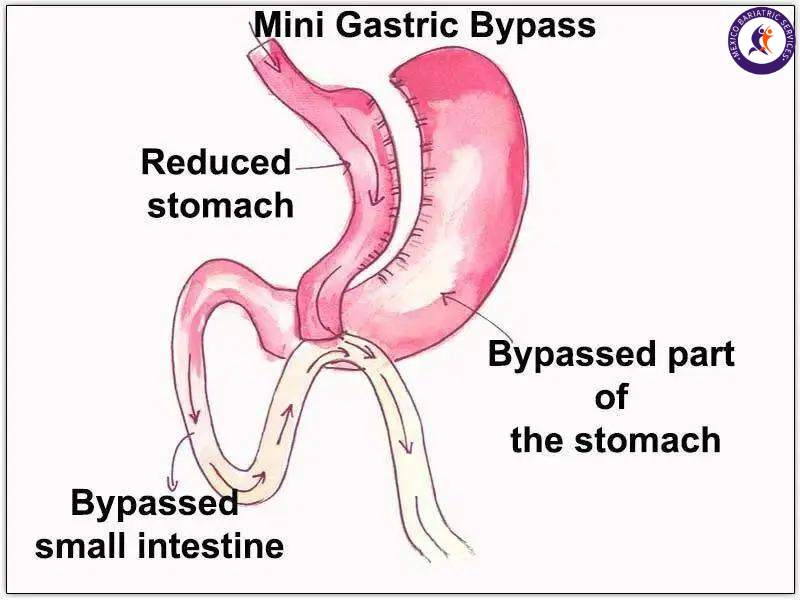 Mini Gastric Bypass 