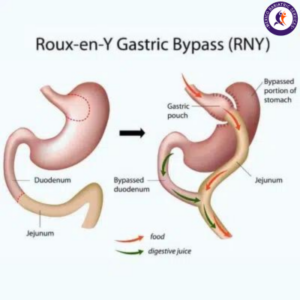 Gastric Bypass Surgery for Weight loss surgery in Puerto Vallarta