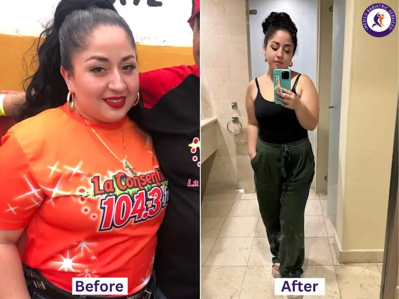 Daniela achieved her weight loss transformation in just 3 months with gastric sleeve in Piedras Negras