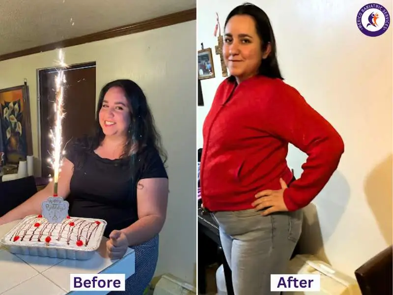 Gastric sleeve in Piedras Negras helped Eloisa achieve amazing results in just 1.5 months!