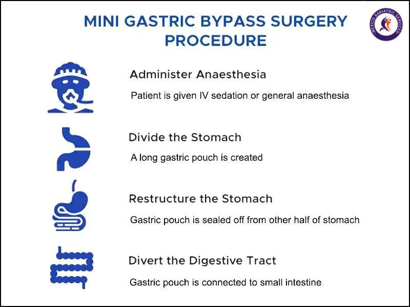 Mini Gastric Bypass Surgery Procedure