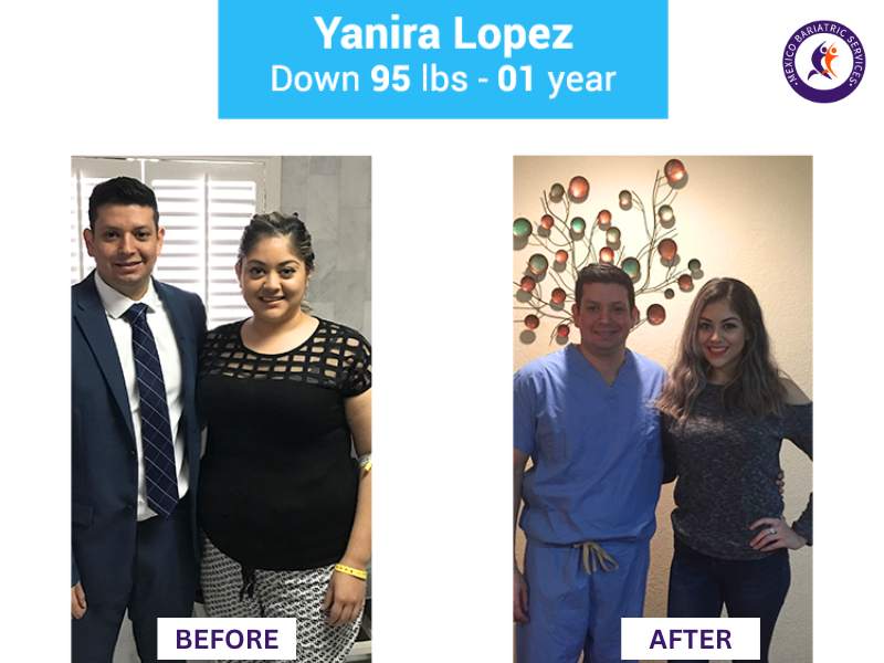 Weight loss surgery in Nuevo Laredo Before and After