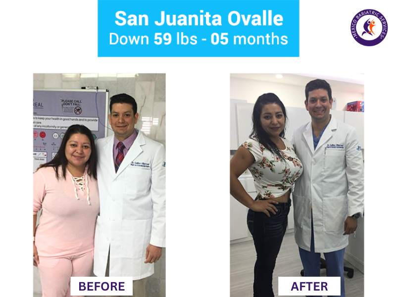 Weight loss surgery in Nuevo Laredo Before and After