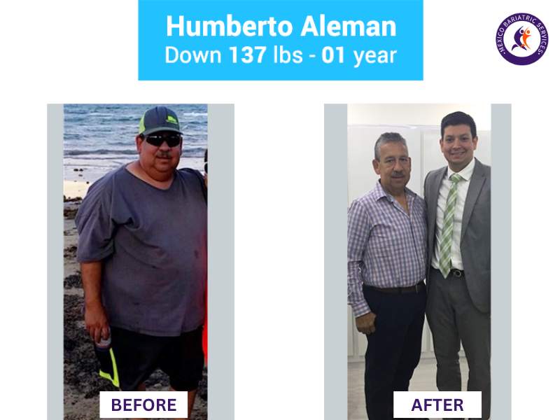 Weight loss surgery in Nuevo Laredo Before and After