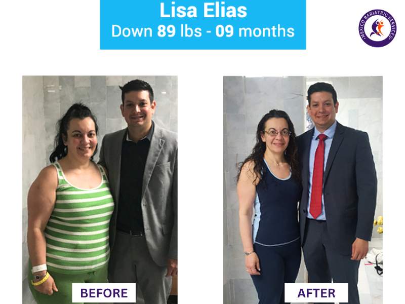 Weight loss surgery in Nuevo Laredo Before and After