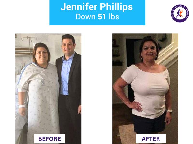 Weight loss surgery in Nuevo Laredo Before and After