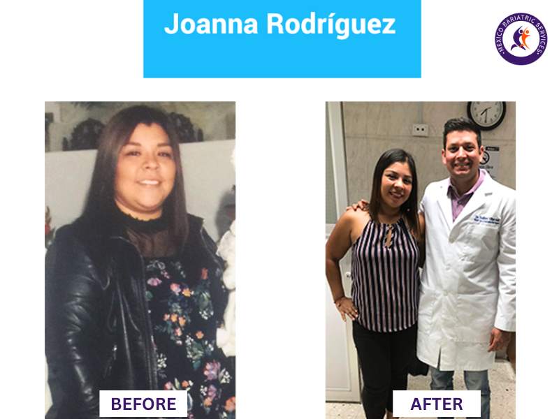 Weight loss surgery in Nuevo Laredo Before and After