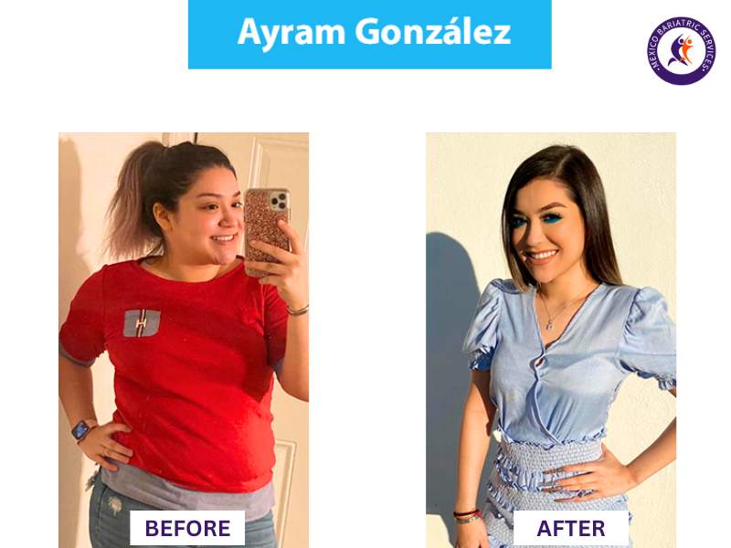 Weight loss surgery in Nuevo Laredo Before and After