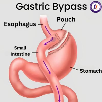 Gastric Bypass Gastric Bypass