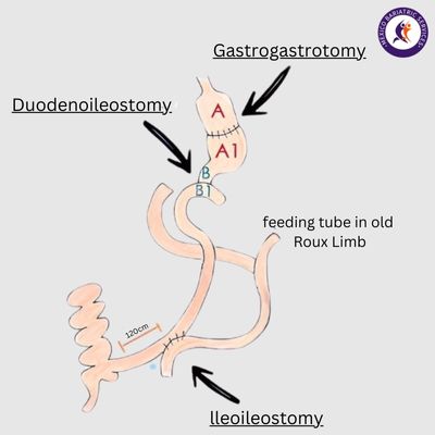Duodenal Switch Duodenal Switch