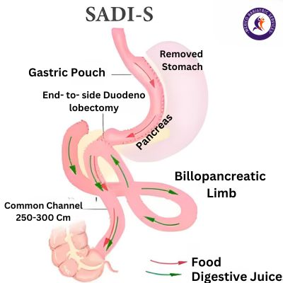 SADI-S Gastric Bypass SADI-S Gastric Bypass