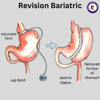 Revision Bariatric Surgery Revision Bariatric Surgery
