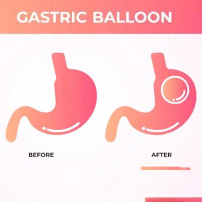 Gastric Balloon Gastric Balloon