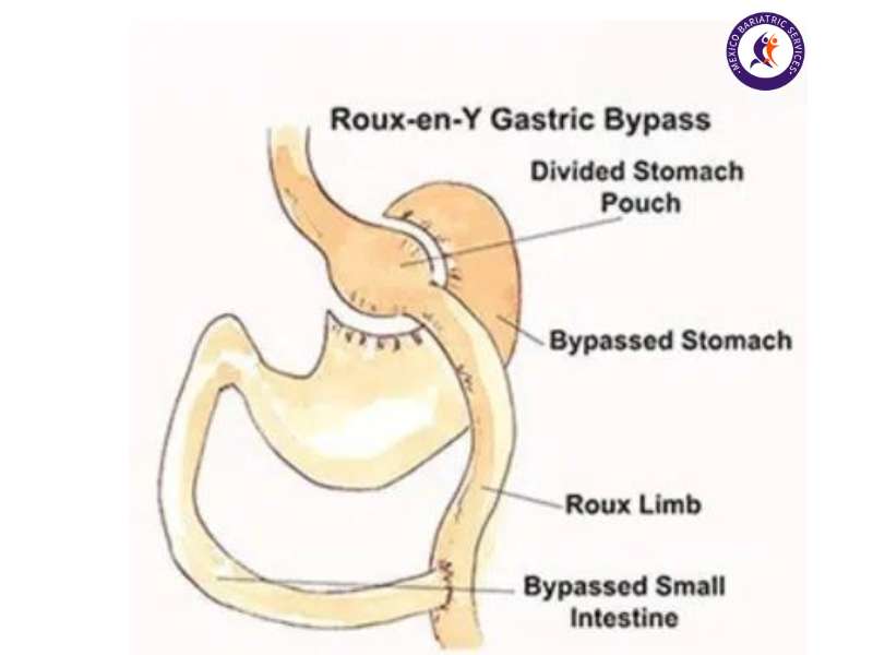 Gastric Bypass Surgery