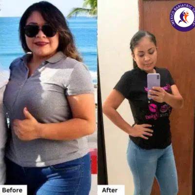Weight Loss Surgery, Before & After Before & After